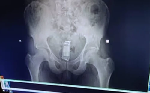 পায়ুপথ থেকে মোবাইল উদ্ধার 