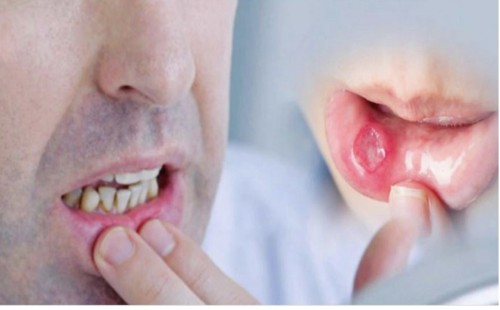 মুখের ক্যান্সারের ৫ লক্ষণ 
