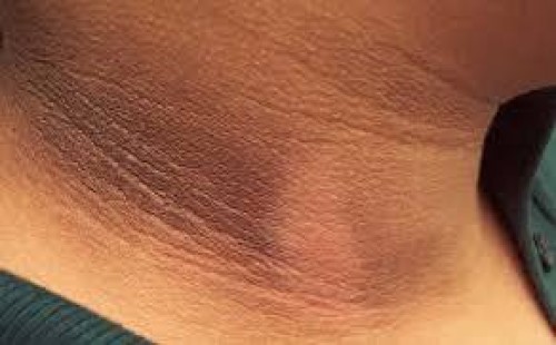 গলার নিচে কালো দাগ দূর করার সহজ উপায় 