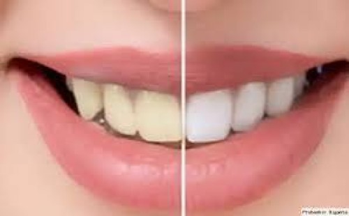 দাঁতের হলদে ভাব দূর করার পদ্ধতি 