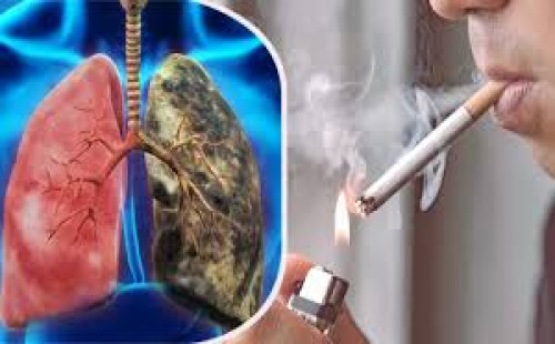 ধূমপান ছাড়ার পর কি ফুসফুস ক্যান্সারের ঝুঁকি কমে? যা জানাচ্ছেন চিকিৎসক 
